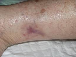 Arterielle hypertonie (100%),diabetes mellitus (60%) pavk (50%). Key Elements To Understanding Martorell Ulcer Elena Conde Montero