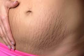 Jangan hilangkan stretch mark saat hamil, kenapa? 11 Cara Menghilangkan Stretch Mark Medis Alami