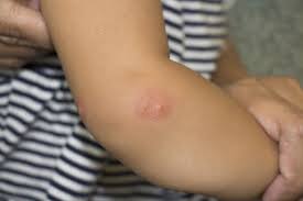 Image result for mosquito bite
