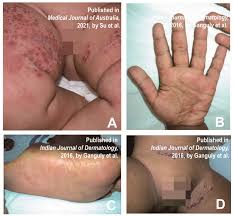 Image result for Hand foot and mouth disease HFMD roof of mouth