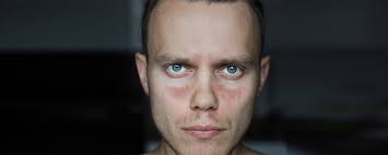 Image result for Panniculitis