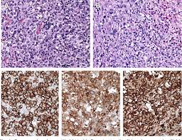 Grey zone lymphomas are lymphatic tumors that cannot be assigned to a defined lymphoma entity due to morphological, clinical or genetic reasons. Gray Zone Lymphoma Current Diagnosis And Treatment Options Semantic Scholar