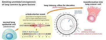 People with lung cancer can experience shortness of breath if cancer grows to block the major airways. Early Genome Catastrophes Can Cause Non Smoking Lung Cancer