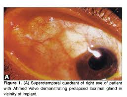 Image result for Seidel Test