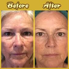 I-24K yeGolide yeCollagen ixobula imaski-Ayithengiswa ezivenkileni