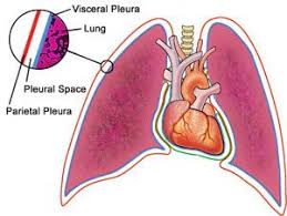 Clinical features include initial complaints of nonpleuritic chest pain and dyspnea. Pleural Mesothelioma Mesothelioma Pleural Effusion Clinical Coding