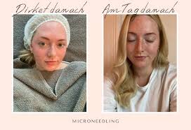 3 freunde wein grauburgunder, zitate sehen mit dem herzen, stephen hawking alter, die 50 beliebtesten frauen im internet, jeans herstellung in china, motogp. Microneedling Alles Zur Behandlung Erfahrungen Beauty Report