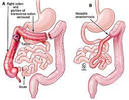 Ileosigmoidal anastomosis and cecorectal anastomosis. ç›´è‚›å¤–ç§' Colorectal Resections ç™½è¢ææ‡¼ç—‡ ç—žå®¢é‚¦