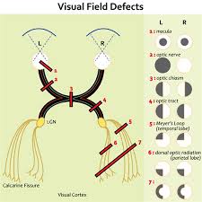 Image result for Visual Field Deficit