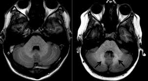 I don't know which way to turn yet. Gadolinium Deposition In The Brain Not Dose Dependent