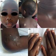 Juvenile dermatomyositis in a 4‐year‐old Kenyan girl