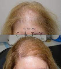 Dhea is likely to raise levels of testosterone and dihydrotestosterone (dht) in the hair follicles. Nyc Female Hair Loss Treatment New York Androgenic Alopecia Women