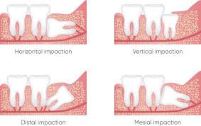 Clotting at the extraction site starts to form within the first 24 hours of the extraction procedure. Wisdom Teeth Removal Neutral Bay Elite Dentistry