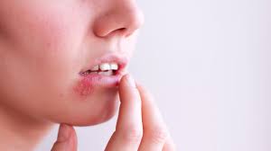 Hsv1 is known for affecting the area on and around the lips, and occasionally on other parts of the face. Differences Between Hsv 1 And Hsv 2 Oral And Genital Herpes Allure