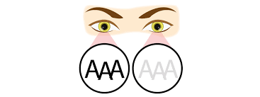 Image result for Amblyopia