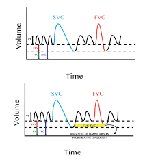 Image result for Vital Capacity