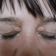 Image result for xanthelasma of eyelid