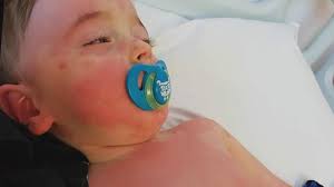 Coronavirus in children with medical conditions. New Covid 19 Symptom Can Cause Inflammation In Children Youtube