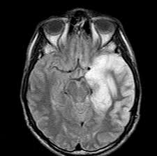 Image result for HSV Encephalitis