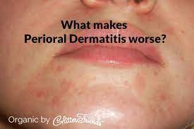 Perioral Dermatitis Perioral Dermatitis Perioral Skin Eczema