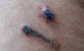 Keloid scars occur when the skin overreacts to the injury, after which they grow and darken. Dermatech Permanent Cosmetics
