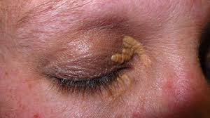 Image result for xanthelasma of eyelid