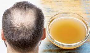 Apply this to your wet hair and scalp. Hair Loss Treatment Apple Cider Vinegar Could Increase Hair Growth Express Co Uk