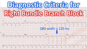 Image result for Right Bundle Branch Block
