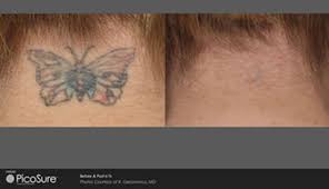 This location offers grooming, petshotel, doggie day camp, training, adoptions, veterinary and curbside pickup. Fast Laser Tattoo Removal Picosure Greenville Sc