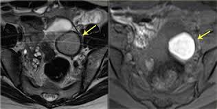 Ultrasound scans including transabdominal, transvaginal, and transrectal imaging are the most common imaging tests for endometriosis along with mri. Endometriosis Ovarian Cysts Shefalitayal