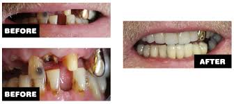 And bear in mind that your credit the gadget spec url could not be found. Dental Bridges Leicester Dentist 44 Dental Care