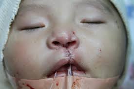 Medical Missions for Children (MMFC)