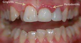 How To Treat Periodontal Disease With Natural Remedies - Singla Dental