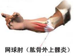 第3版 — 北京：北京语言大学出版社，2008 — 165页本书是为《汉语会话301句》课本编写的练. ä¸æ…Žæ‚£ä¸Šç¶²çƒè‚˜æ‡‰å¦‚ä½•æ²»ç™‚ æ¯æ—¥é ­æ¢