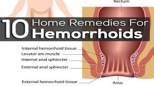 Internal Hemorrhoids Hemorrhoid Symptoms Home Remedies For Hemorrhoi Hemorrhoids Treatment Home Remedies For Hemorrhoids Hemorrhoid Remedies
