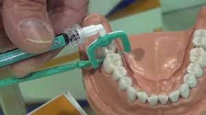 The first procedure that is to be done before a dentist start the procedure for filling a cavity is that the tooth must be thoroughly cleaned by hand instruments and mechanical rotary instruments, called hand pieces. Filling Cavities Without Drilling North County San Diego Youtube