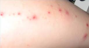 How To Treat A Rash From A Dog Scratch