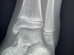 Image result for Ankle XRay