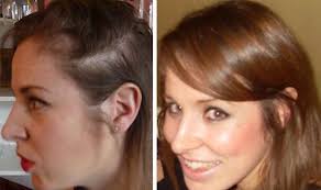 Vegan diet stop hair loss info. I Learned The Bald Truth About My Hair Loss From Unflattering Christmas Party Pictures Express Co Uk