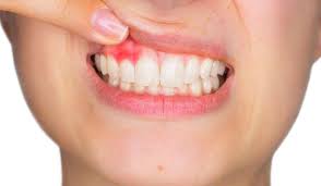The fact is that if the receding persists after home remedies, you may have to resort to medical treatments to make gums grow back. Dentalfeature Do Gums Grow Back The Number One Concern About Gum Recession Caribbean News