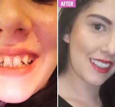 Mum praises £199 clip-on veneers for transforming her smile after she was  rejected from jobs over her 'tombstone teeth'