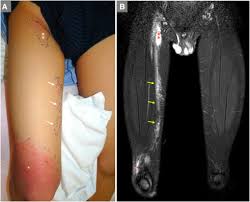 Image result for Nodular Lymphangitis