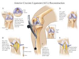 Anterior Cruciate Ligament Acl Reconstruction Compel Visuals Cruciate Ligament Tear Cruciate Ligament Acl Recovery
