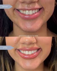 Who wants a lip flip? 🤩 We cannot get over how beautiful this end result  is with just a few units of botox! Schedule your lip flip today for $115.  📲 (734)