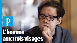 Jérôme Hamon, le seul homme au monde à avoir été greffé deux fois au visage