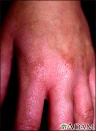 Image result for Linear Dermatitis