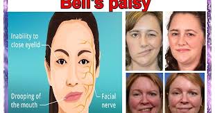 Kerana sifat serangan bell's palsy adalah lumpuh atau lemah pada sebelah muka kerana kerosakan kepada saraf ketujuh (iaitu saraf muka) tengkorak, yang bertanggungjawab untuk mengawal otot muka. Bell S Palsy Sure Shahbaz Khan Sir