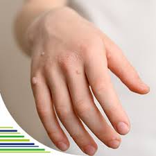 Image result for Akutní zánět nehtového lůžka