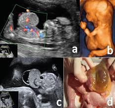 Fetal Abdominal Wall Defects Intechopen