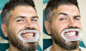 If you're searching for an even better fit, you can have a custom mouthguard created at your dentist's office. Teeth Whitening Northbrook Il Advance Family Dental Care